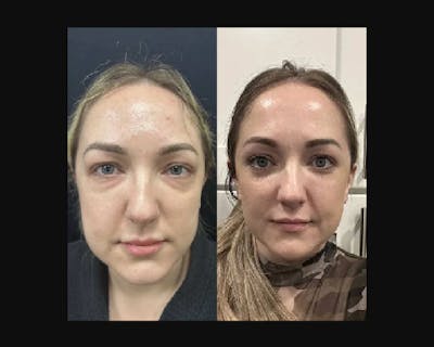 Lower Blepharoplasty Before & After Gallery - Patient 113928 - Image 2
