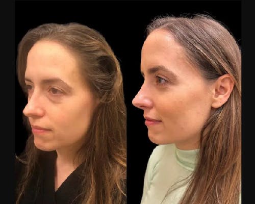 Lower Blepharoplasty Before & After Gallery - Patient 402618 - Image 2