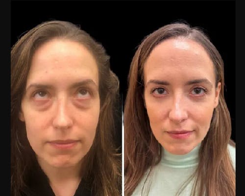 Lower Blepharoplasty Before & After Gallery - Patient 402618 - Image 3