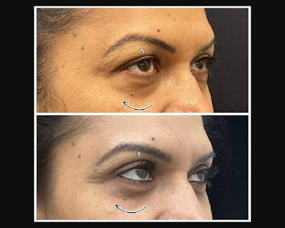 Lower Blepharoplasty Before & After Gallery - Patient 370175 - Image 1