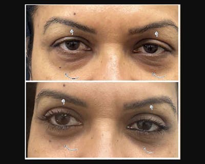 Lower Blepharoplasty Before & After Gallery - Patient 370175 - Image 2