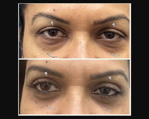 Lower Blepharoplasty Before & After Gallery - Patient 370175 - Image 2