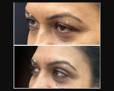 Lower Blepharoplasty Before & After Gallery - Patient 370175 - Image 3