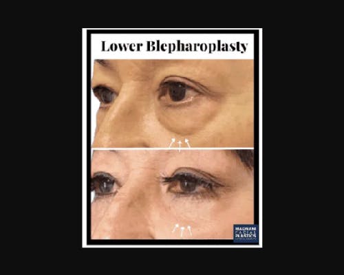 Lower Blepharoplasty Before & After Gallery - Patient 147930 - Image 1
