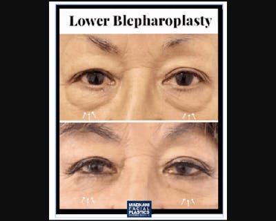 Lower Blepharoplasty Before & After Gallery - Patient 147930 - Image 2