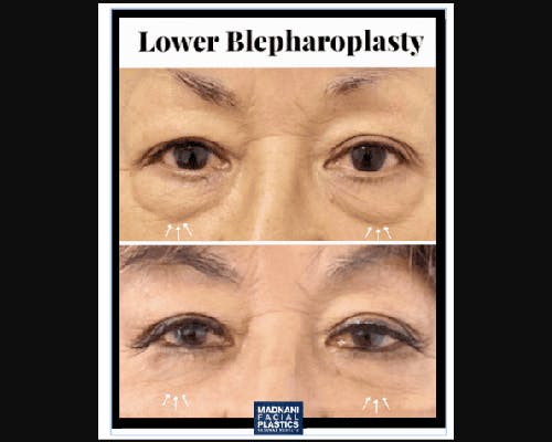 Lower Blepharoplasty Before & After Gallery - Patient 147930 - Image 2