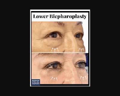 Lower Blepharoplasty Before & After Gallery - Patient 147930 - Image 3