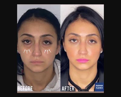 Lower Blepharoplasty Before & After Gallery - Patient 278359 - Image 1