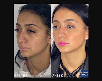 Lower Blepharoplasty Before & After Gallery - Patient 278359 - Image 2