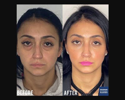 Lower Blepharoplasty Before & After Gallery - Patient 278359 - Image 3