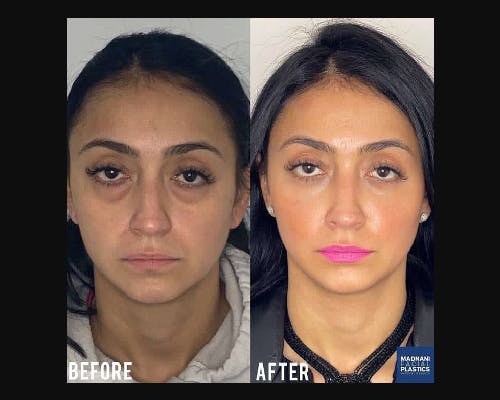 Lower Blepharoplasty Before & After Gallery - Patient 278359 - Image 3