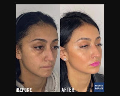 Lower Blepharoplasty Before & After Gallery - Patient 278359 - Image 4