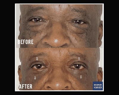 Lower Blepharoplasty Before & After Gallery - Patient 329418 - Image 3