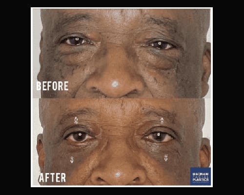 Lower Blepharoplasty Before & After Gallery - Patient 329418 - Image 3