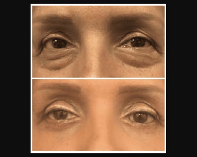 Lower Blepharoplasty Before & After Gallery - Patient 273724 - Image 1