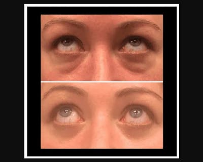 Lower Blepharoplasty Before & After Gallery - Patient 177767 - Image 1
