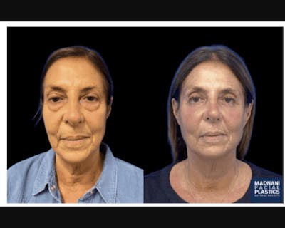 Lower Blepharoplasty Before & After Gallery - Patient 233810 - Image 1