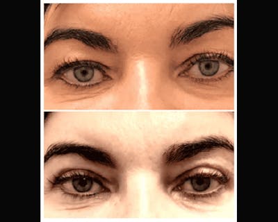 Upper Blepharoplasty Before & After Gallery - Patient 266701 - Image 1