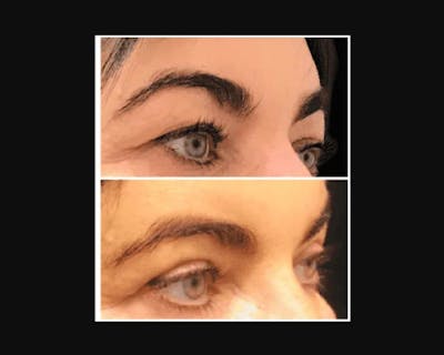 Upper Blepharoplasty Before & After Gallery - Patient 266701 - Image 2
