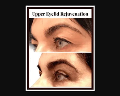 Upper Blepharoplasty Before & After Gallery - Patient 266701 - Image 3