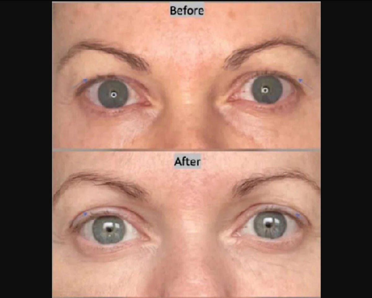 Upper Blepharoplasty Before & After Gallery - Patient 253337 - Image 1
