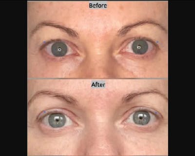 Upper Blepharoplasty Before & After Gallery - Patient 253337 - Image 1