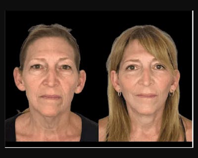 Upper Blepharoplasty Before & After Gallery - Patient 618879 - Image 1