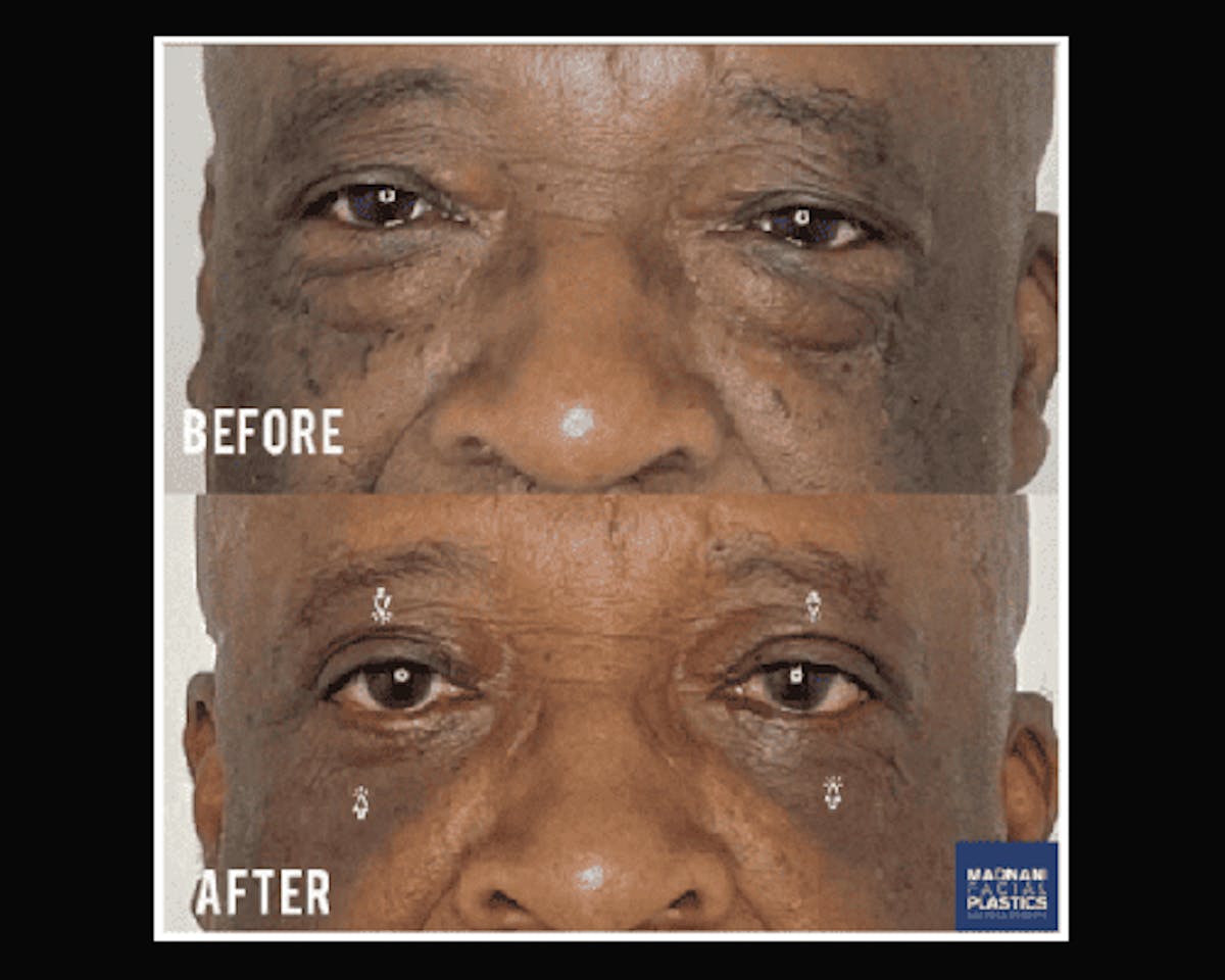  Upper Blepharoplasty Before & After Gallery - Patient 342230 - Image 1