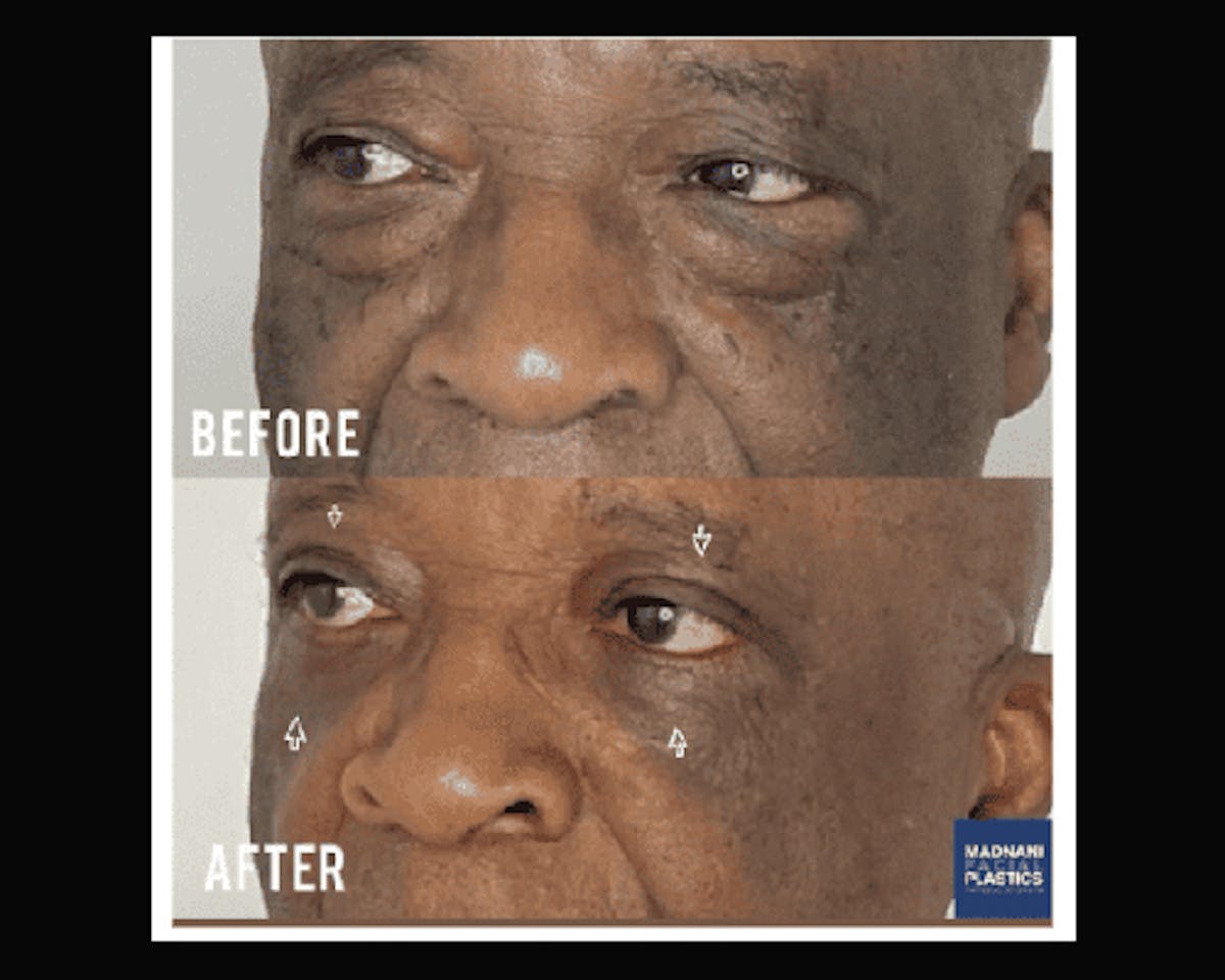  Upper Blepharoplasty Before & After Gallery - Patient 342230 - Image 2
