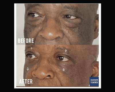 Upper Blepharoplasty Before & After Gallery - Patient 342230 - Image 2