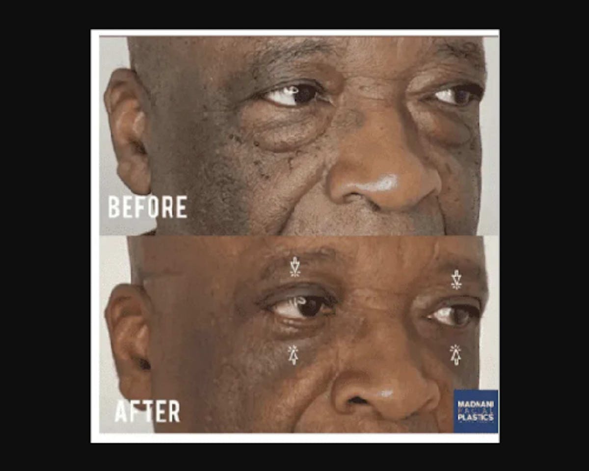  Upper Blepharoplasty Before & After Gallery - Patient 342230 - Image 3