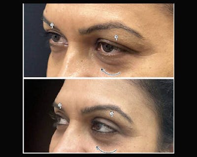 Upper Blepharoplasty Before & After Gallery - Patient 411473 - Image 1