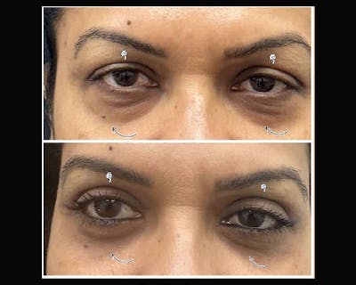 Upper Blepharoplasty Before & After Gallery - Patient 411473 - Image 2