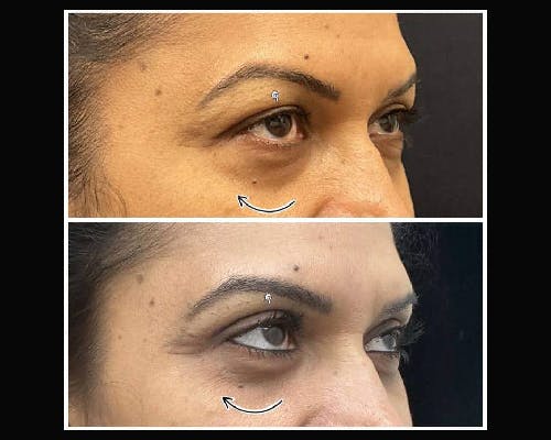 Upper Blepharoplasty Before & After Gallery - Patient 411473 - Image 3