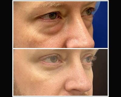 Upper Blepharoplasty Before & After Gallery - Patient 310054 - Image 1