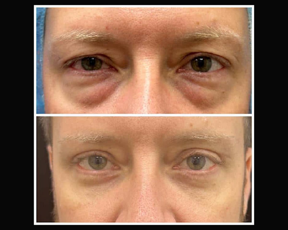  Upper Blepharoplasty Before & After Gallery - Patient 310054 - Image 3