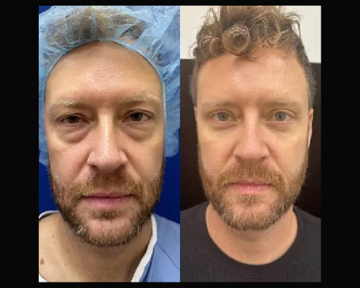  Upper Blepharoplasty Before & After Gallery - Patient 310054 - Image 4
