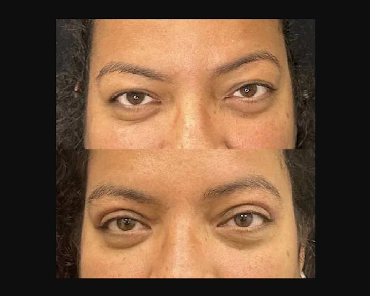  Upper Blepharoplasty Before & After Gallery - Patient 175823 - Image 1