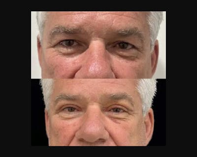 Upper Blepharoplasty Before & After Gallery - Patient 100824 - Image 1