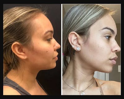 Buccal Fat Reduction Before & After Gallery - Patient 832615 - Image 1