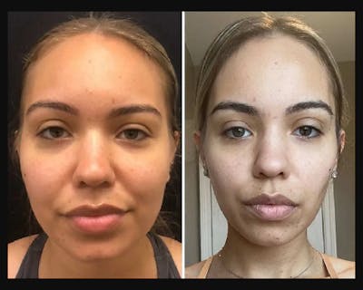 Buccal Fat Reduction Before & After Gallery - Patient 832615 - Image 2