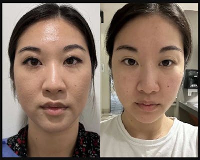 Buccal Fat Reduction Before & After Gallery - Patient 223731 - Image 1