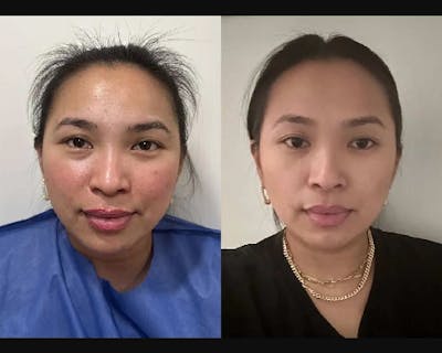 Buccal Fat Reduction Before & After Gallery - Patient 865051 - Image 1