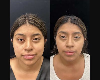 Buccal Fat Reduction Before & After Gallery - Patient 316109 - Image 1