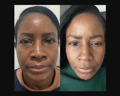 Buccal Fat Reduction Before & After Gallery - Patient 422840 - Image 1