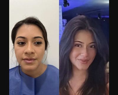 Buccal Fat Reduction Before & After Gallery - Patient 119356 - Image 1