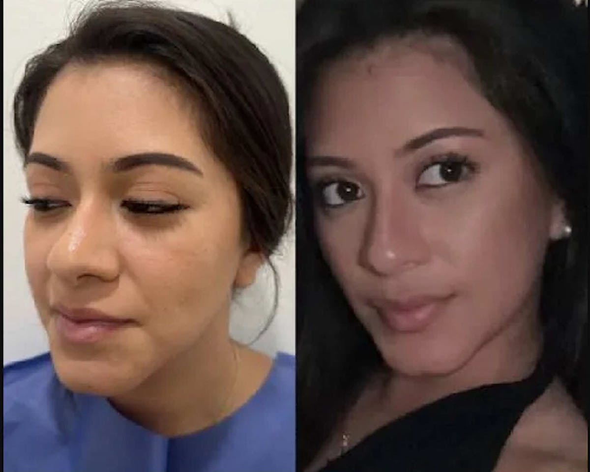 Buccal Fat Reduction Before & After Gallery - Patient 119356 - Image 2