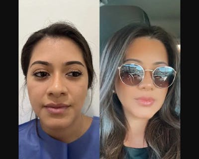 Buccal Fat Reduction Before & After Gallery - Patient 119356 - Image 3