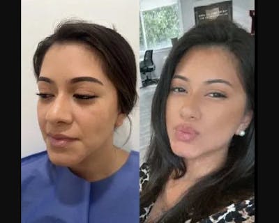 Buccal Fat Reduction Before & After Gallery - Patient 119356 - Image 4