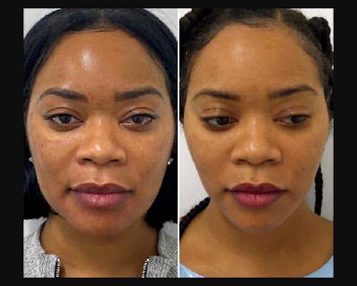 Buccal Fat Reduction Before & After Gallery - Patient 314217 - Image 1
